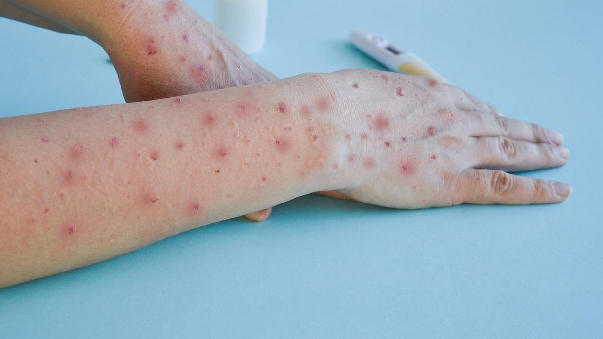 Amazonas registra 74 casos confirmados de mpox “varíola dos macacos”, e alerta para prevenção