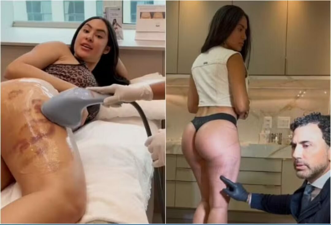 Isabelle Nogueira conclui etapa do tratamento de celulite, e Matteus reage: “É visível”