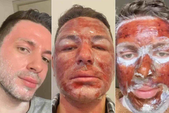 Peeling fenol: entenda o procedimento que promete rejuvenescer a pele